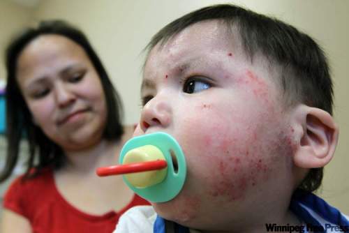 JOE.BRYKSA@FREEPRESS.MB.CA
Valene Flett is worried about her son Jacob’s rash and if it will heal.