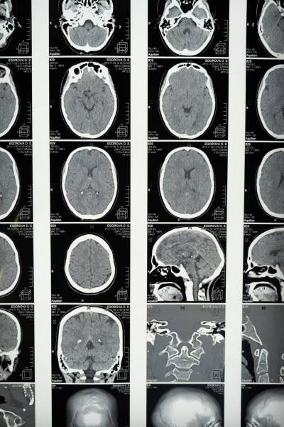 PEXELS IMAGE
                                More study is need on brain injuries related to domestic violence.