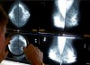 Manitoba government has announced a plan to expand breast cancer screening for the second time in a month. A radiologist uses a magnifying glass to check mammograms for breast cancer in Los Angeles, May 6, 2010. THE CANADIAN PRESS/AP-Damian Dovarganes