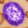 The Associated Press Files
                                An electron microscope image of a measles virus particle.